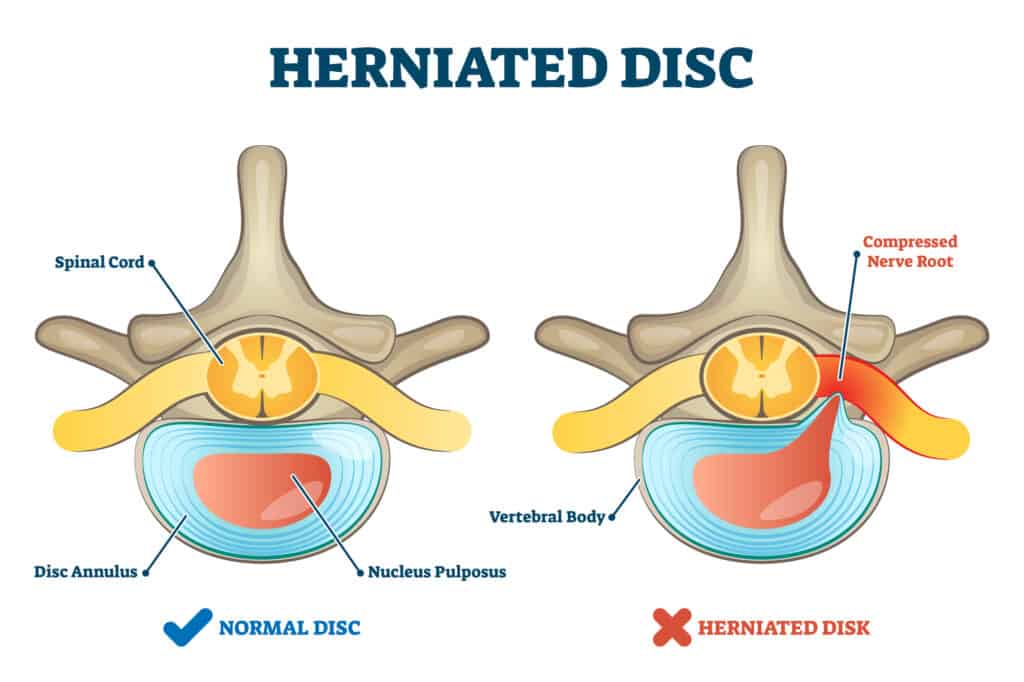 Herniated disc injury as labeled spinal pain explanation vector illustration. Medical condition with back bone trauma and nerve root compression by nucleus pulposus. Problematic example comparison.
