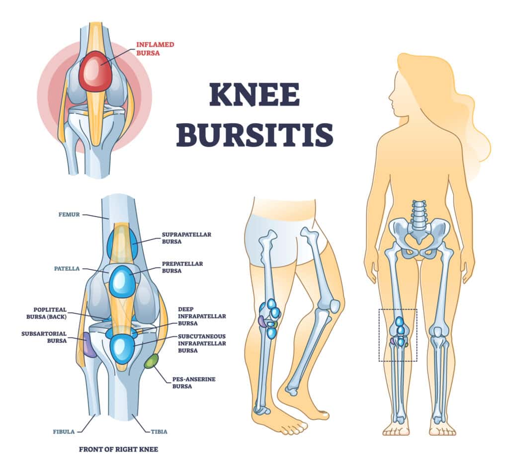 Knee bursitis condition with fluid filled bursa in leg joint outline diagram. Labeled educational medical liquid growth anatomy scheme with chronic leg inflammation pathology vector illustration.