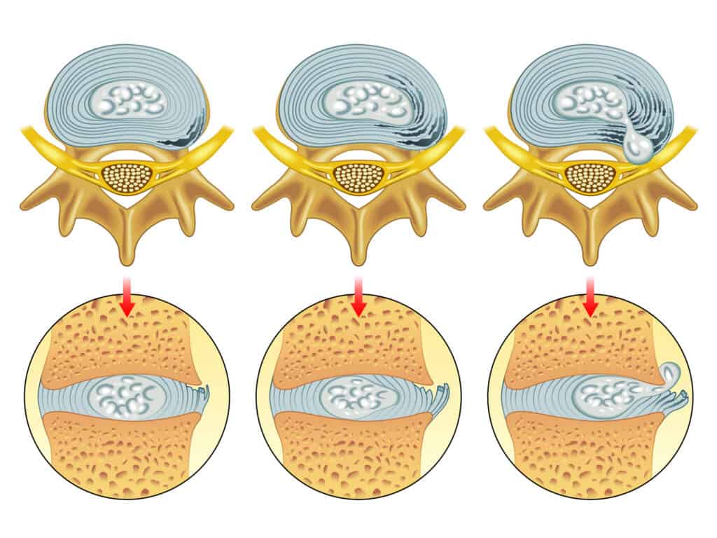 images showing progression of a disc herniation. 