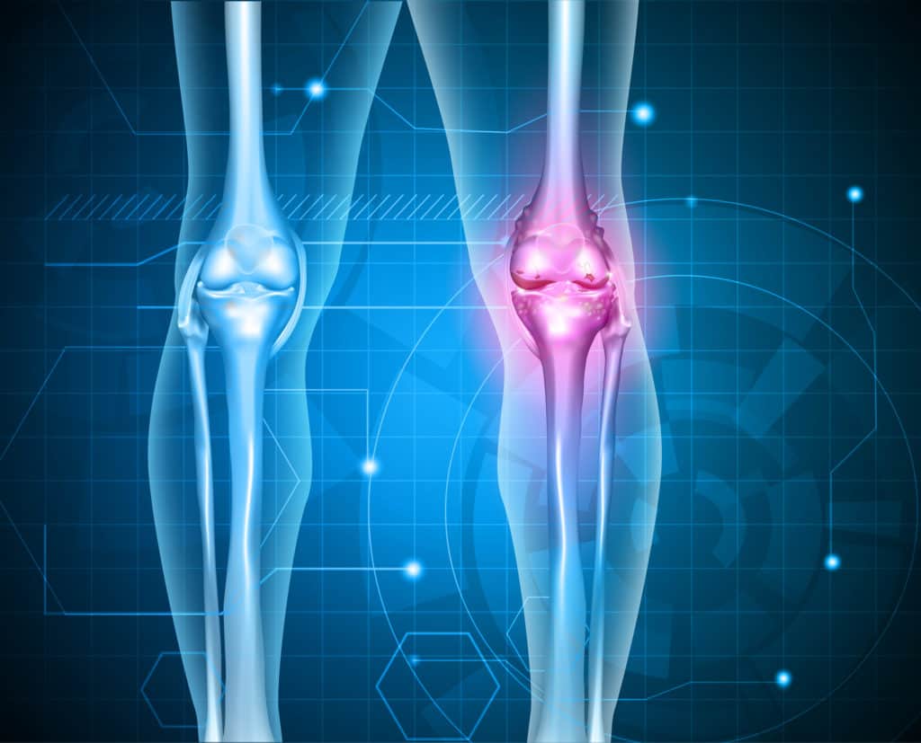 Understand Xray And MRI Imaging With Osteoarthritis