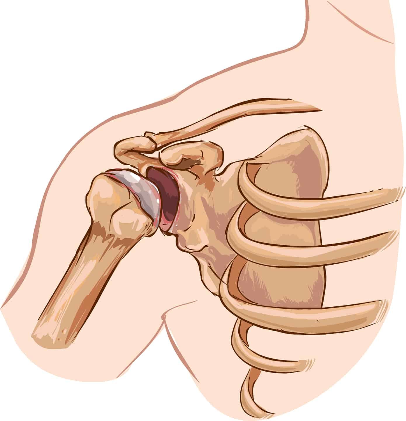 dislocated shoulder on a diagram